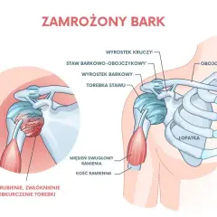 Ilustracja przedstawia zamrożony bark, pokazując pogrubienie i zwłóknienie torebki stawu. Ćwiczenia mogą pomóc w leczeniu bólu barku.