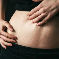 Brzuch kobiety z widocznymi rozstępami, dłonie dotykają skóry.
