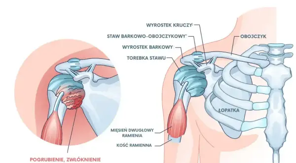 Ilustracja przedstawia zamrożony bark, pokazując pogrubienie i zwłóknienie torebki stawu. Ćwiczenia mogą pomóc w leczeniu bólu barku.