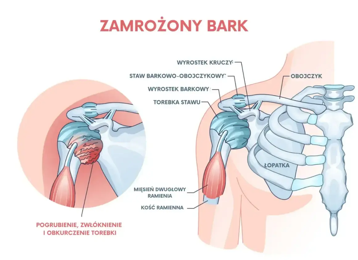 Ilustracja przedstawia zamrożony bark, pokazując pogrubienie i zwłóknienie torebki stawu. Ćwiczenia mogą pomóc w leczeniu bólu barku.