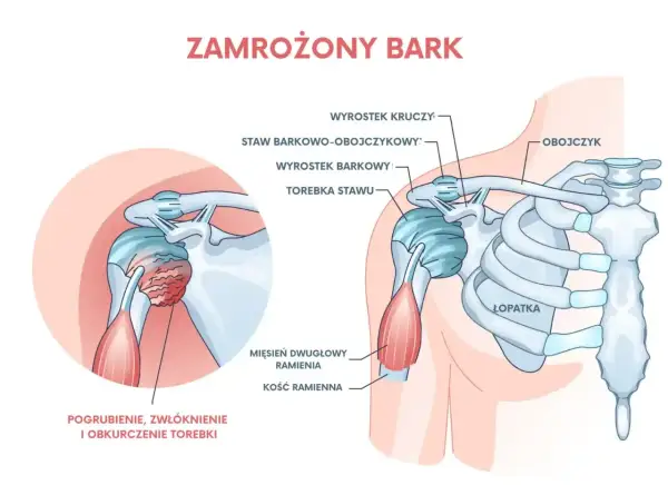 Ilustracja przedstawia zamrożony bark, pokazując pogrubienie i zwłóknienie torebki stawu. Ćwiczenia mogą pomóc w leczeniu bólu barku.